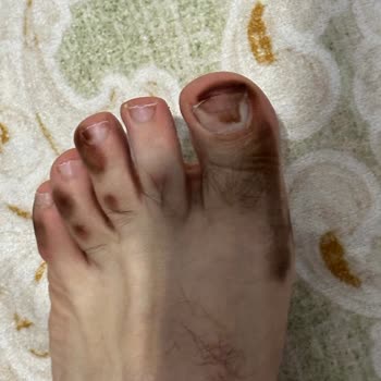 Greyder Deri Ayakkabı Ayak Boyaması Nedeniyle Ücret İadesi Talebi