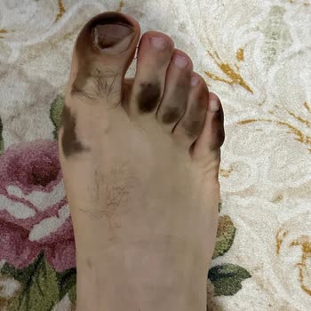 Greyder Deri Ayakkabı Ayak Boyaması Nedeniyle Ücret İadesi Talebi