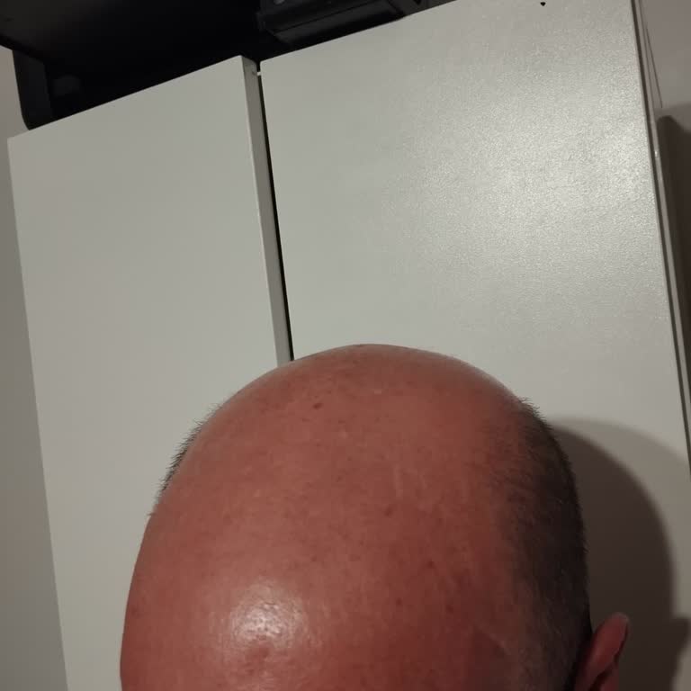 12.000 TL'lik Saç Mezoterapisi Sözünü Tutmadı, Sonuçsuz Ve Sahte Seans Kayıtları