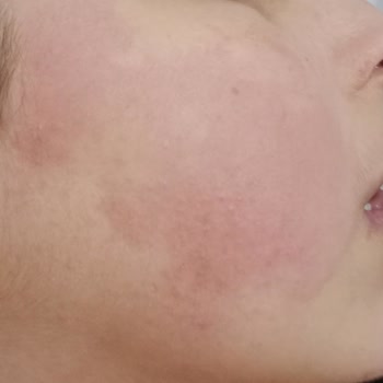 Sebamed Şampuanı Kızımda Yüz Kızarıklığına Neden Olduğu İçin İade İstiyorum