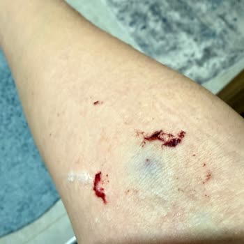 Acil Serviste Damar Yolu İşlemi Sırasında Şiddetli Ağrı Ve Bilgi Eksikliği