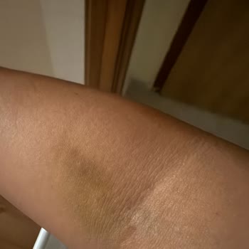 Acil Serviste Damar Yolu İşlemi Sırasında Şiddetli Ağrı Ve Bilgi Eksikliği