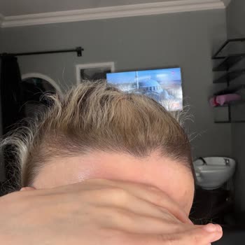 Ombre İşlemi Sonrası Saç Kopması Ve Ücret İadesi Talebi