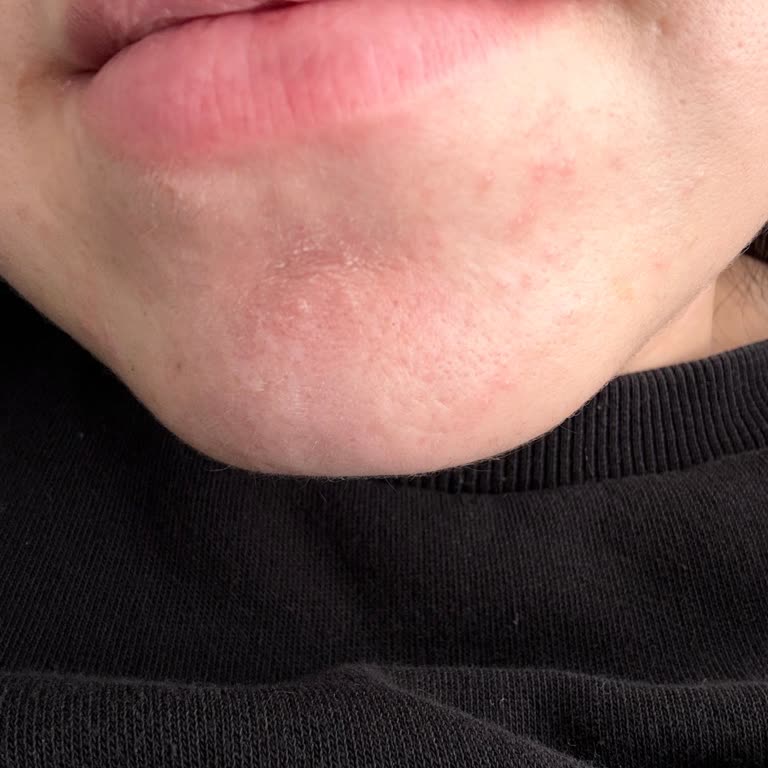 La Roche-Posay Toleriane Cream Caused Severe Skin Rash