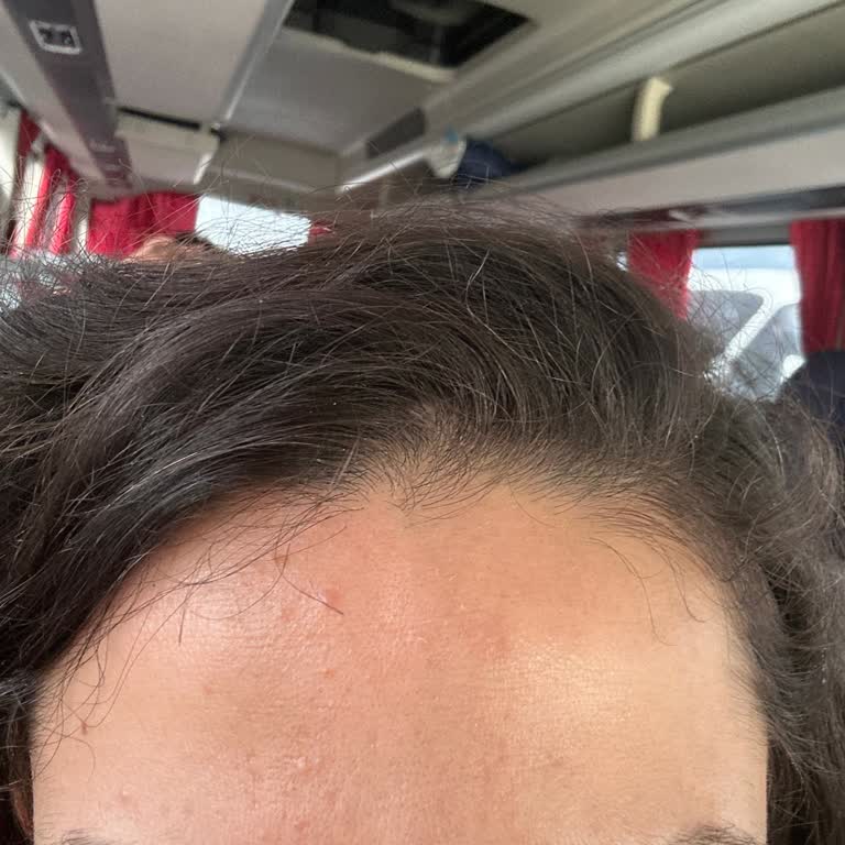 La Roche-Posay C12 Serum Caused Breakouts Across My Face