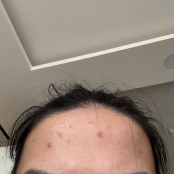 L’Oréal Güneş Kremi Kullanımından Sonra Şiddetli Sivilce Patlaması