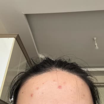 L’Oréal Güneş Kremi Kullanımından Sonra Şiddetli Sivilce Patlaması