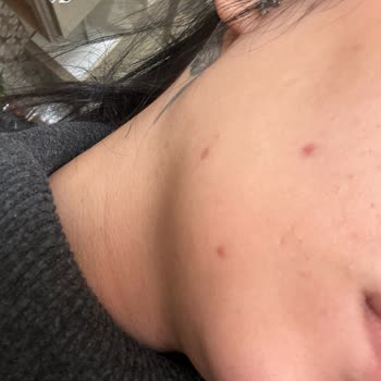 L’Oréal Güneş Kremi Kullanımından Sonra Şiddetli Sivilce Patlaması