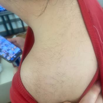 Livangel Güzellik’te Kısa Seanslar Ve Kalitesiz Lazer Epilasyon Sonrası Şiddetli Kıllanma