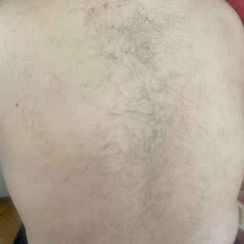 Livangel Güzellik’te Kısa Seanslar Ve Kalitesiz Lazer Epilasyon Sonrası Şiddetli Kıllanma