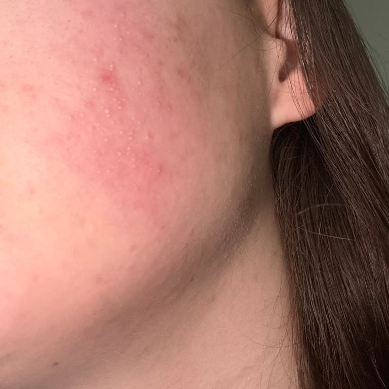 L’Oreal Glass Skin Maskesinde Şiddetli Cilt Reaksiyonu Ve İnceleme Talebi