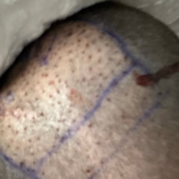 Lux Man Saç Ekimi Merkezi Sosyal Medya İle İnsanları Yanıltıyor