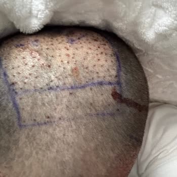 Lux Man Saç Ekimi Merkezi Sosyal Medya İle İnsanları Yanıltıyor