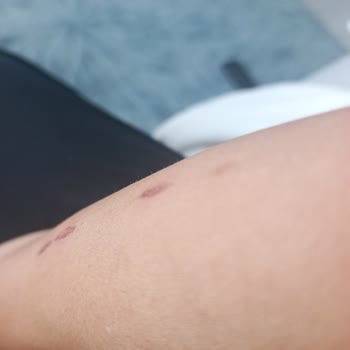 Lazer Epilasyon Sonrası Yanıklar Ve Ücret İadesi Talebi