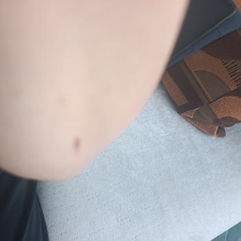 Lazer Epilasyon Sonrası Yanıklar Ve Ücret İadesi Talebi