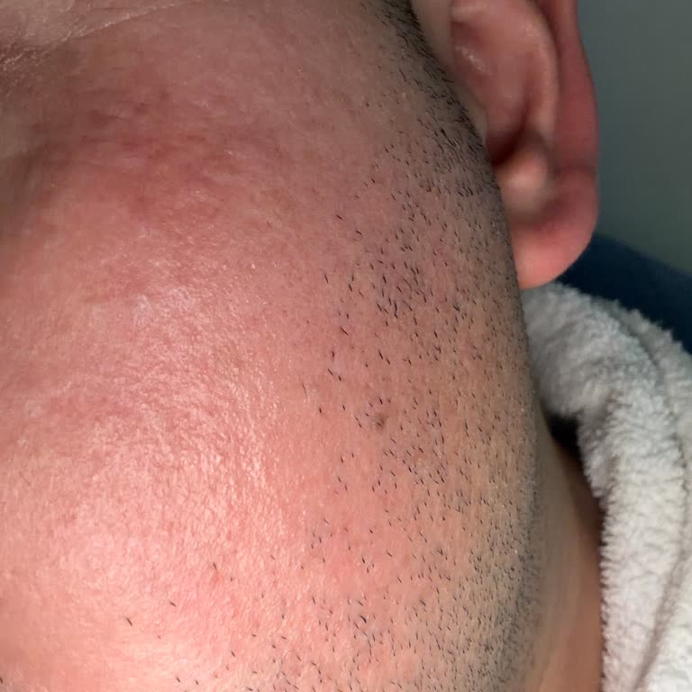 Şırnak Gratis'ten Aldığım Sebamed Şampuanı Yüz Ve Boyun Yanması