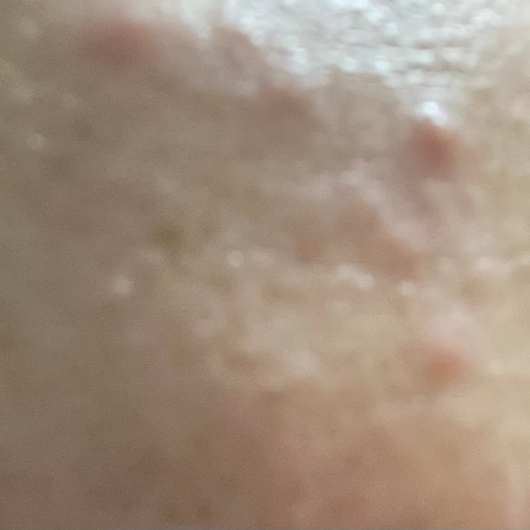 Purest BB Kremiyle Ciltte Alerjik Reaksiyon Ve Şiddetli Sivilcelenme