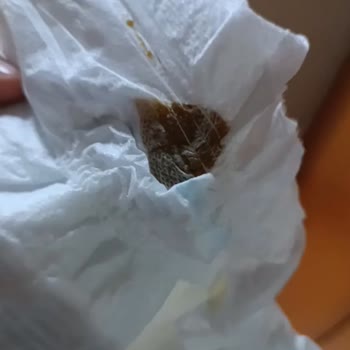 Molfix Bebek Bezinde Yabancı Madde Görülmesi Güveni Sarsıyor