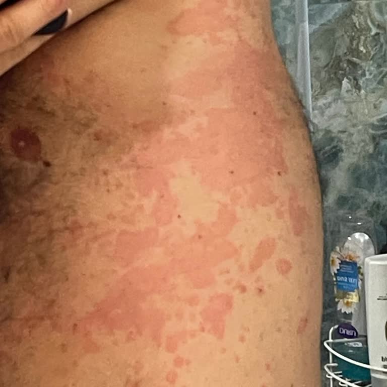 Geçmiş Son Kullanma Tarihli Badem Ürünü Aldığımda Şiddetli Alerjik Reaksiyon