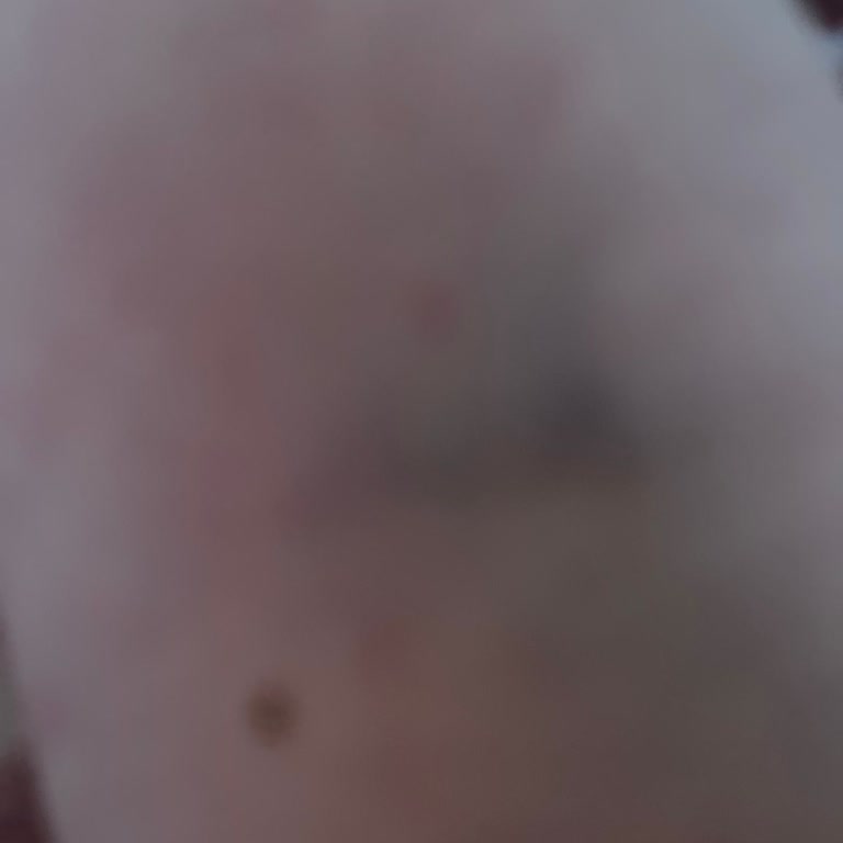 Acil Serviste Hemşirelerin Damar Yolu Açmadaki Yetersizliği Ve Azarlayıcı Üslubu