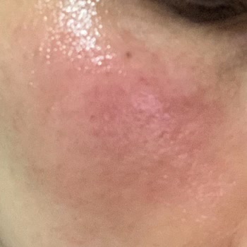 DrClaris BBL İşleminde Yüzümü Yakıtlar