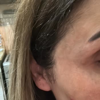 DrClaris BBL İşleminde Yüzümü Yakıtlar