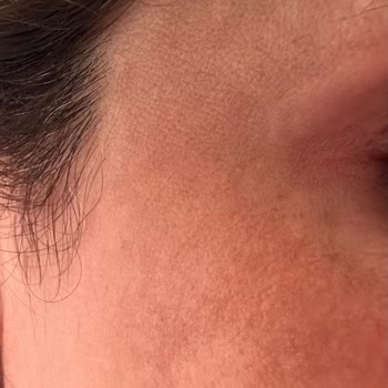 DrClaris BBL İşleminde Yüzümü Yakıtlar