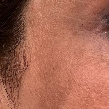 DrClaris BBL İşleminde Yüzümü Yakıtlar