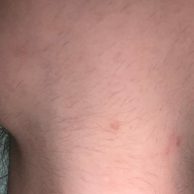 Lazer Uygulamasından İstenmeyen Boyun Tüylenmesi Ve Sürekli Randevu İptalleri