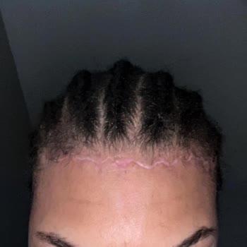 iMed Medical Leaves Severe Forehead Scar After Unauthorized Surgery