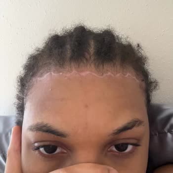 iMed Medical Leaves Severe Forehead Scar After Unauthorized Surgery