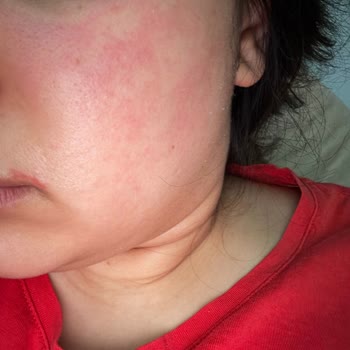 Hametol Kremi Kullanımından Sonra Yüzümde Şiddetli Kızarıklık, Yanma Ve Kaşıntı