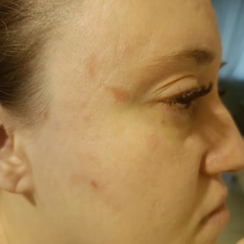 Connex Yufka Patlaması Sonucu İkinci Derece Yanık