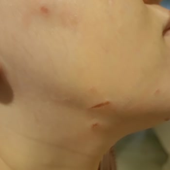 Connex Yufka Patlaması Sonucu İkinci Derece Yanık