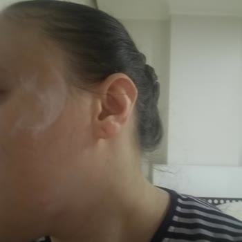 Connex Yufka Patlaması Sonucu İkinci Derece Yanık