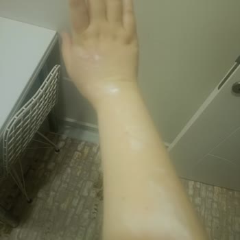 Connex Yufka Patlaması Sonucu İkinci Derece Yanık