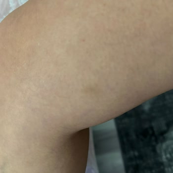 Ayıplı Lazer Epilasyon Ve Haksız Ödeme Talebi