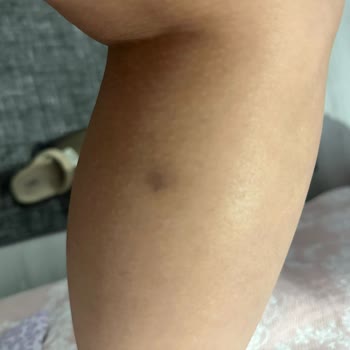 Ayıplı Lazer Epilasyon Ve Haksız Ödeme Talebi