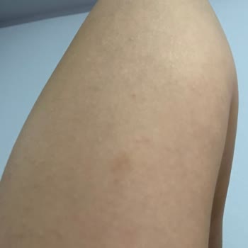 Ayıplı Lazer Epilasyon Ve Haksız Ödeme Talebi