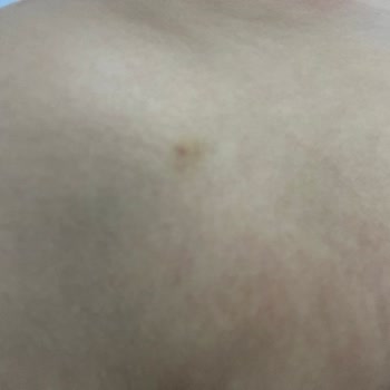 Ayıplı Lazer Epilasyon Ve Haksız Ödeme Talebi