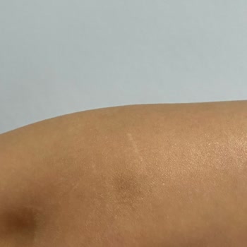 Ayıplı Lazer Epilasyon Ve Haksız Ödeme Talebi