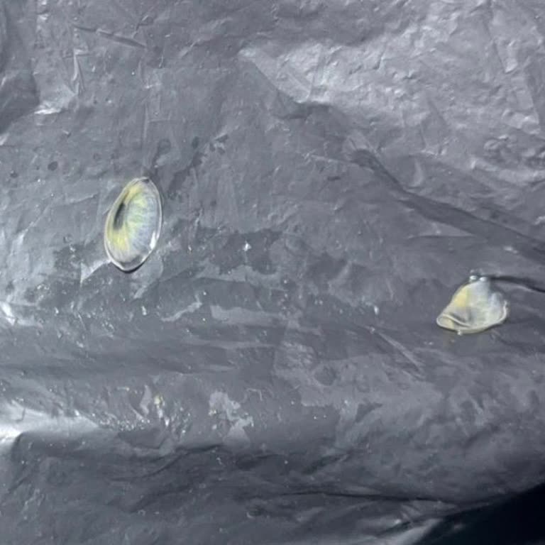 Küçük Lens Göz Yanmasına Ve Yırtılmaya Neden Oldu