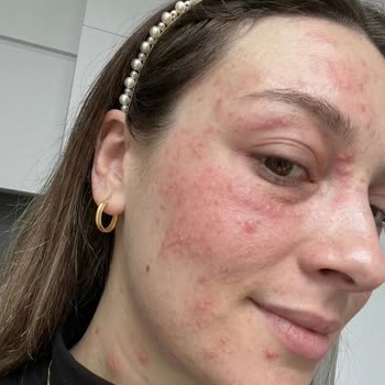 Cilt Bakımı Sonrası Alerjik Reaksiyon Ve 11.000 TL İade Talebi