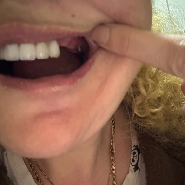 İmplantların Sürekli Çözülmesi Ve Klinik İlgisizliği