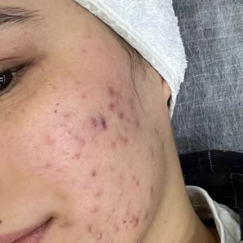 Satış Odaklı Güzellik Merkezi Cilt Sağlığına Zarar Verdi, Ücret İadesi Talebi