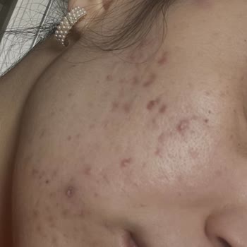 Satış Odaklı Güzellik Merkezi Cilt Sağlığına Zarar Verdi, Ücret İadesi Talebi