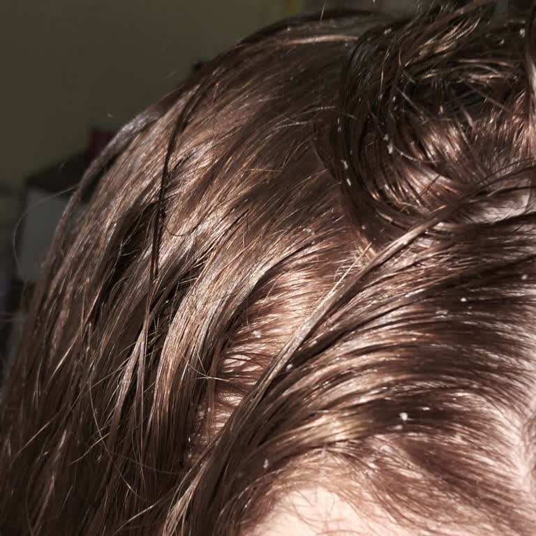 Watsons Head & Shoulders Şampuanı Saç Derimde Aşırı Kepeklenmeye Neden Oldu