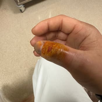 İş Kazası Sonrası Hastane Tedavisindeki İhmali