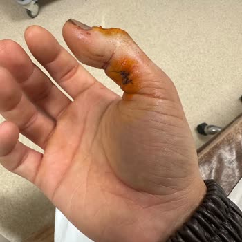 İş Kazası Sonrası Hastane Tedavisindeki İhmali