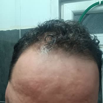 Kiperin Türkiye Kolajen Maskesinin Alerjik Reaksiyonu Ve Trendyol’dan İade Ve Tazminat Talebi